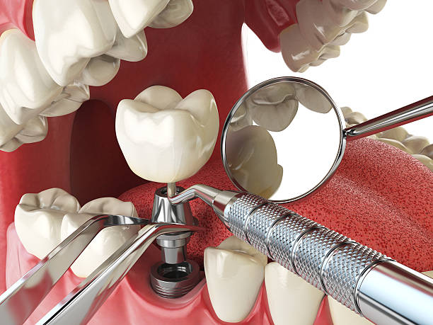 Best Emergency Dentist for Lost Fillings or Crowns in Norris, TN